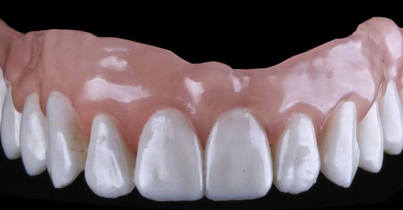 健康・医学 Best Denture Design DSD Denture Design